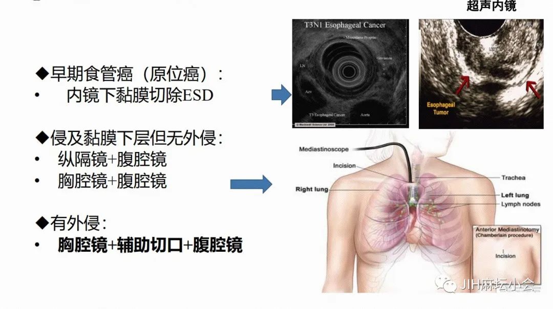 食管癌微(wēi)創手術(shù)的(de)麻醉管理(lǐ)(圖2) 食管癌微(wēi)創手術(shù)的(de)麻醉管理(lǐ)(圖2)