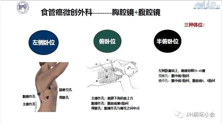 食管癌微(wēi)創手術(shù)的(de)麻醉管理(lǐ)(圖3) 食管癌微(wēi)創手術(shù)的(de)麻醉管理(lǐ)(圖3)