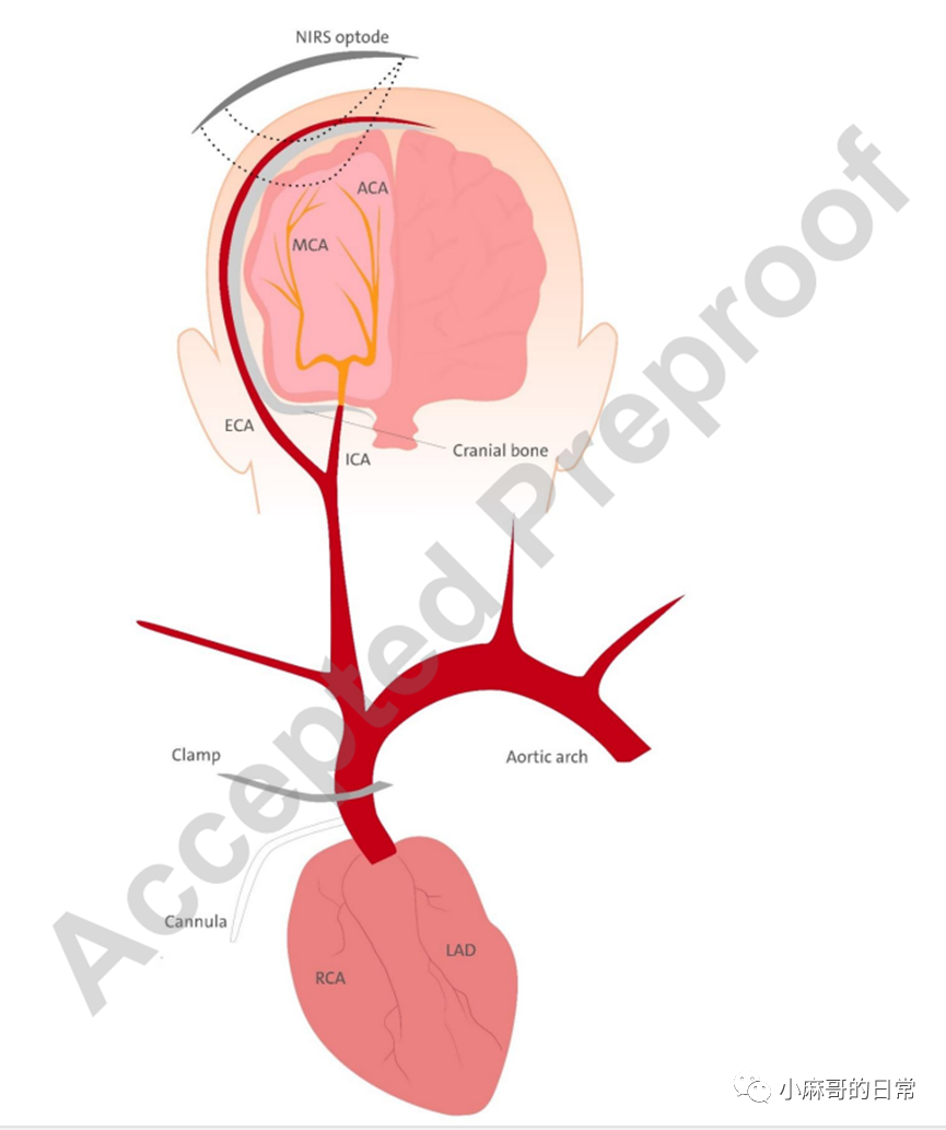 麻醉監測||腦(nǎo)外(wài)污染對(duì)局部腦(nǎo)血氧飽和(hé)度監測的(de)影(yǐng)響(圖2)