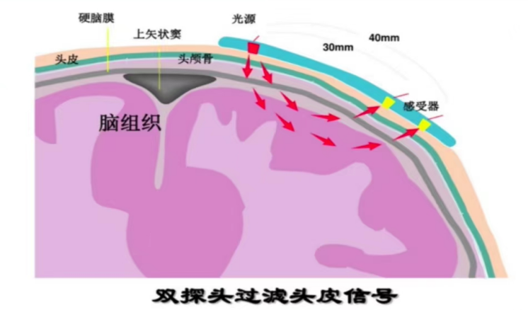 腦(nǎo)氧監測在圍術(shù)期的(de)應用(yòng)(圖2)