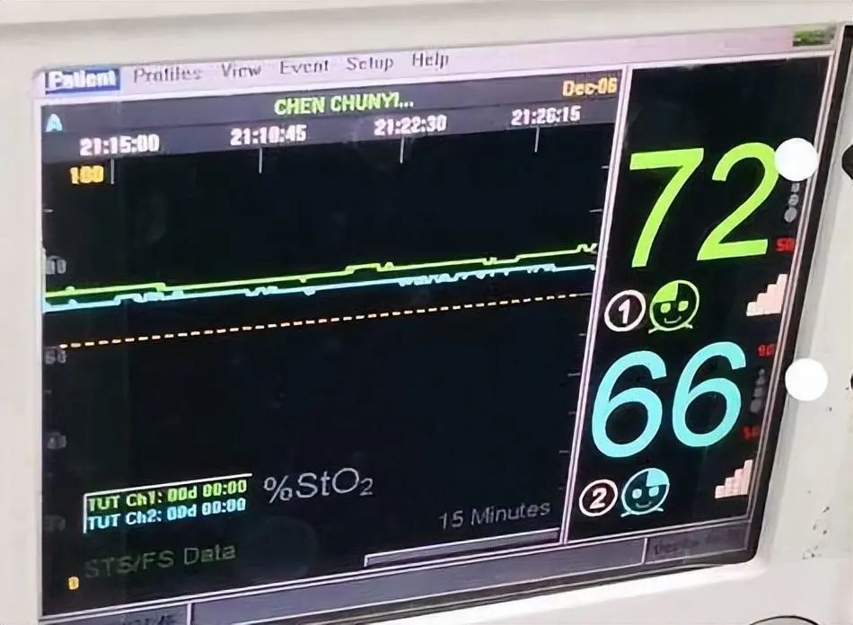 腦(nǎo)氧監測在圍術(shù)期的(de)應用(yòng)(圖5)